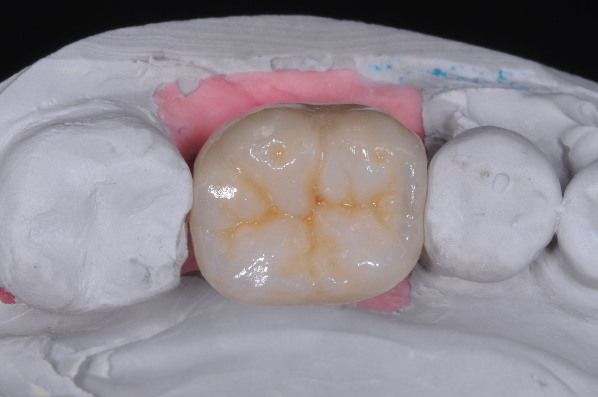 Zirkonkeramikkronen